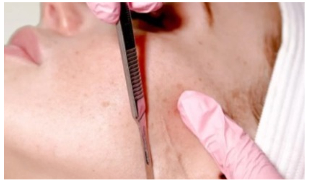 DERMAPLANING